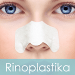 Rinoplastika