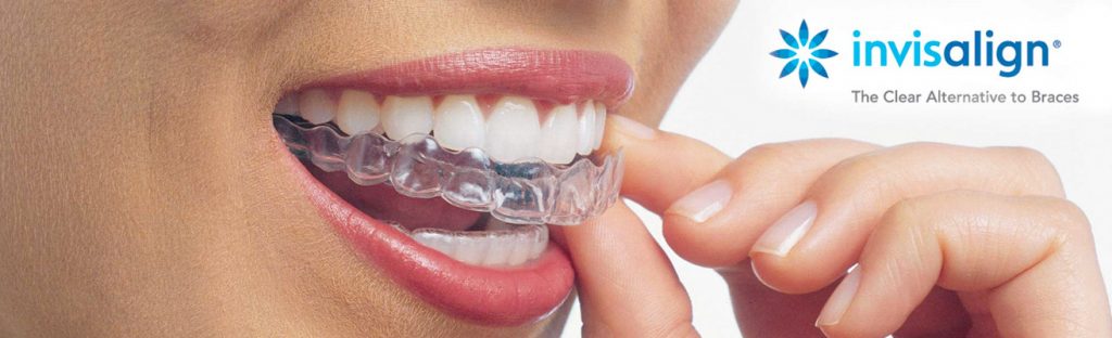 header_invisalign
